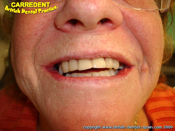 crowns fillings 4 decayed teeth